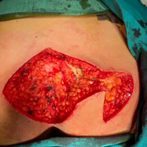 kıl dönmesi tedavisi cerrahi yöntemler