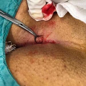 kıl dönmesi tedavisi Fenol İşlemi