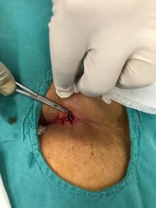 Kıl Dönmesi Hastalığı