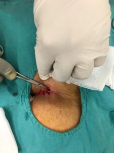 Kıl Dönmesinde Mikro Sinüsektomi Yöntemi