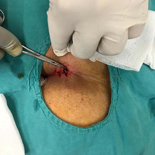 Mikro Sinüsektomi Ameliyatı